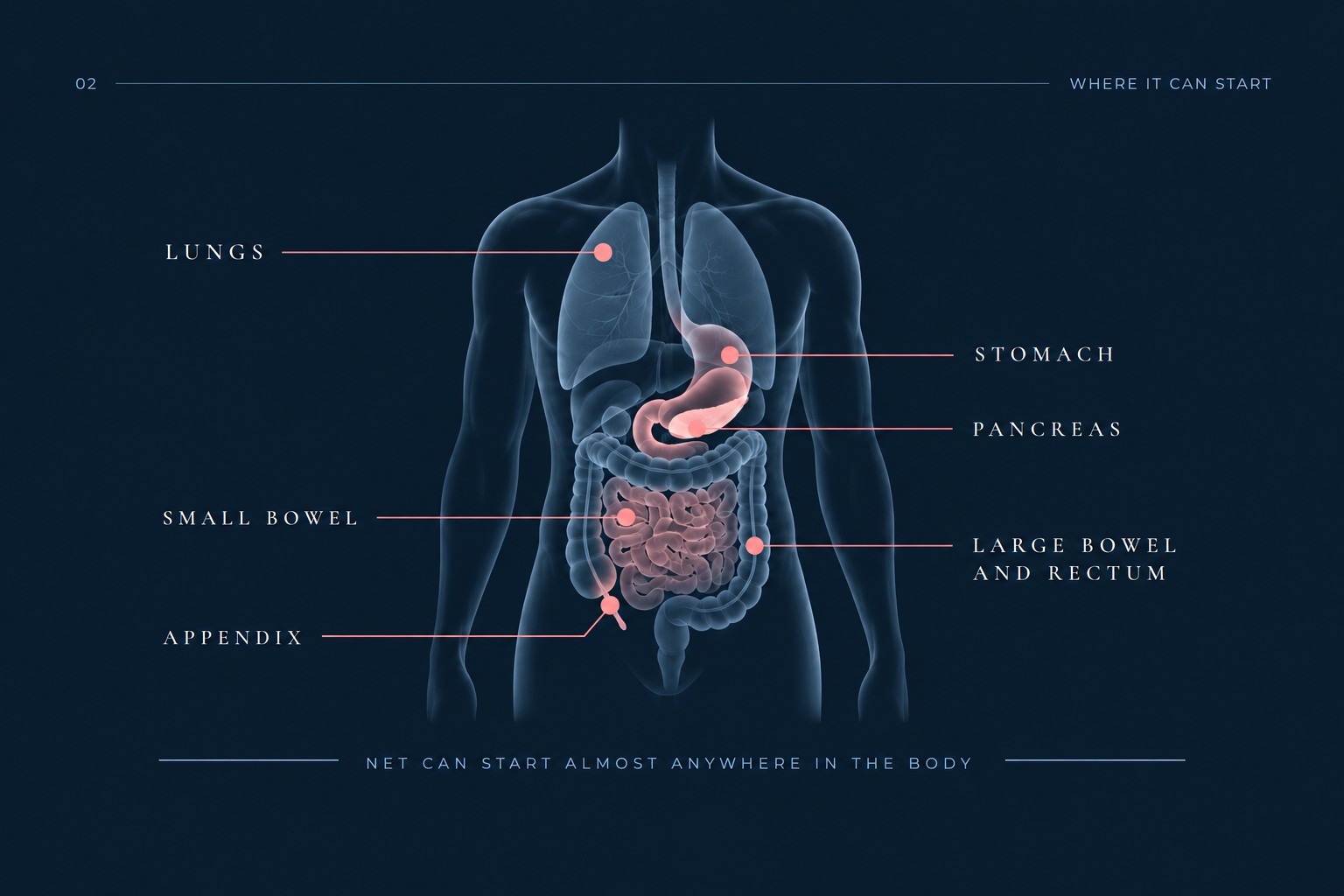 Diagram showing where NET can start in the body: lungs, stomach, pancreas, small bowel, appendix, large bowel and rectum